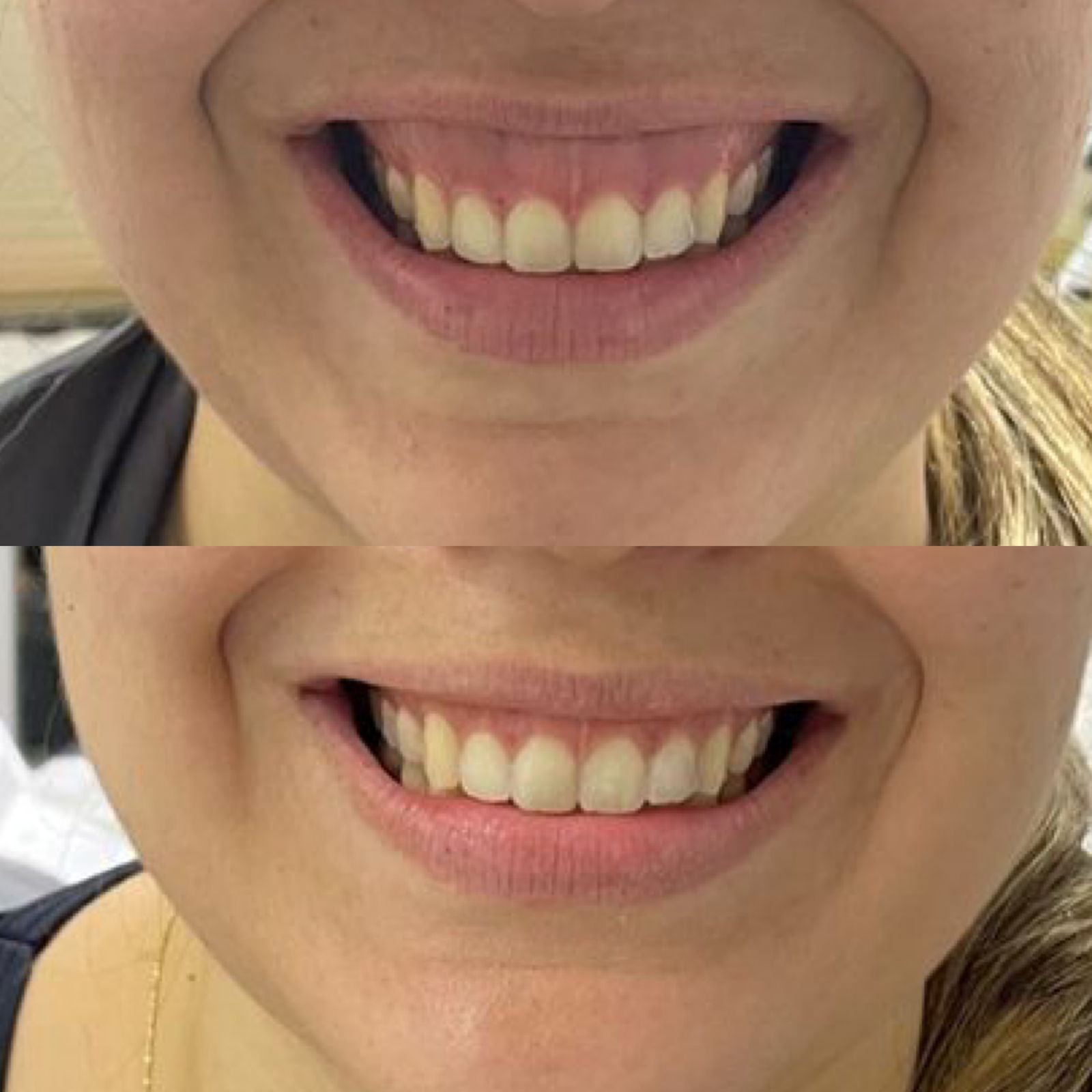 Botox Sorriso Gengival